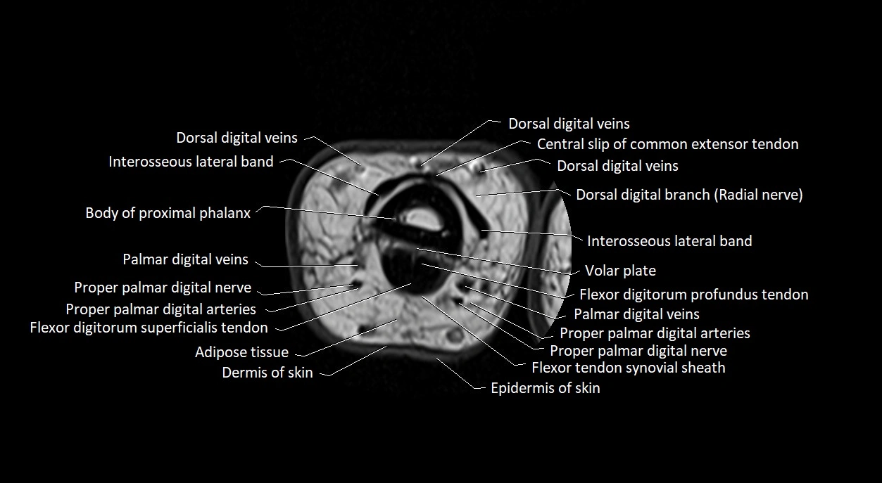 Finger anatomy axial cross sectional 3T image image 16.webp